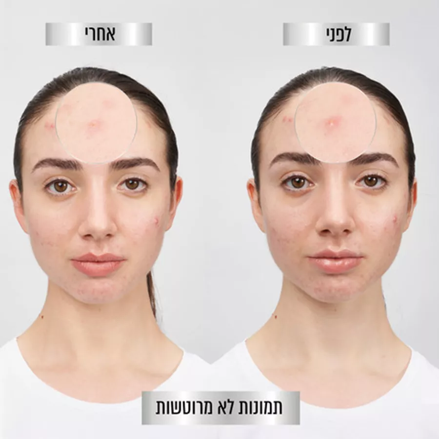 גרנייה מדבקות פצעונים Garnier